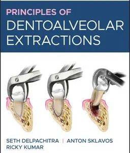 Principles of Dentoalveolar Extractions( Color)